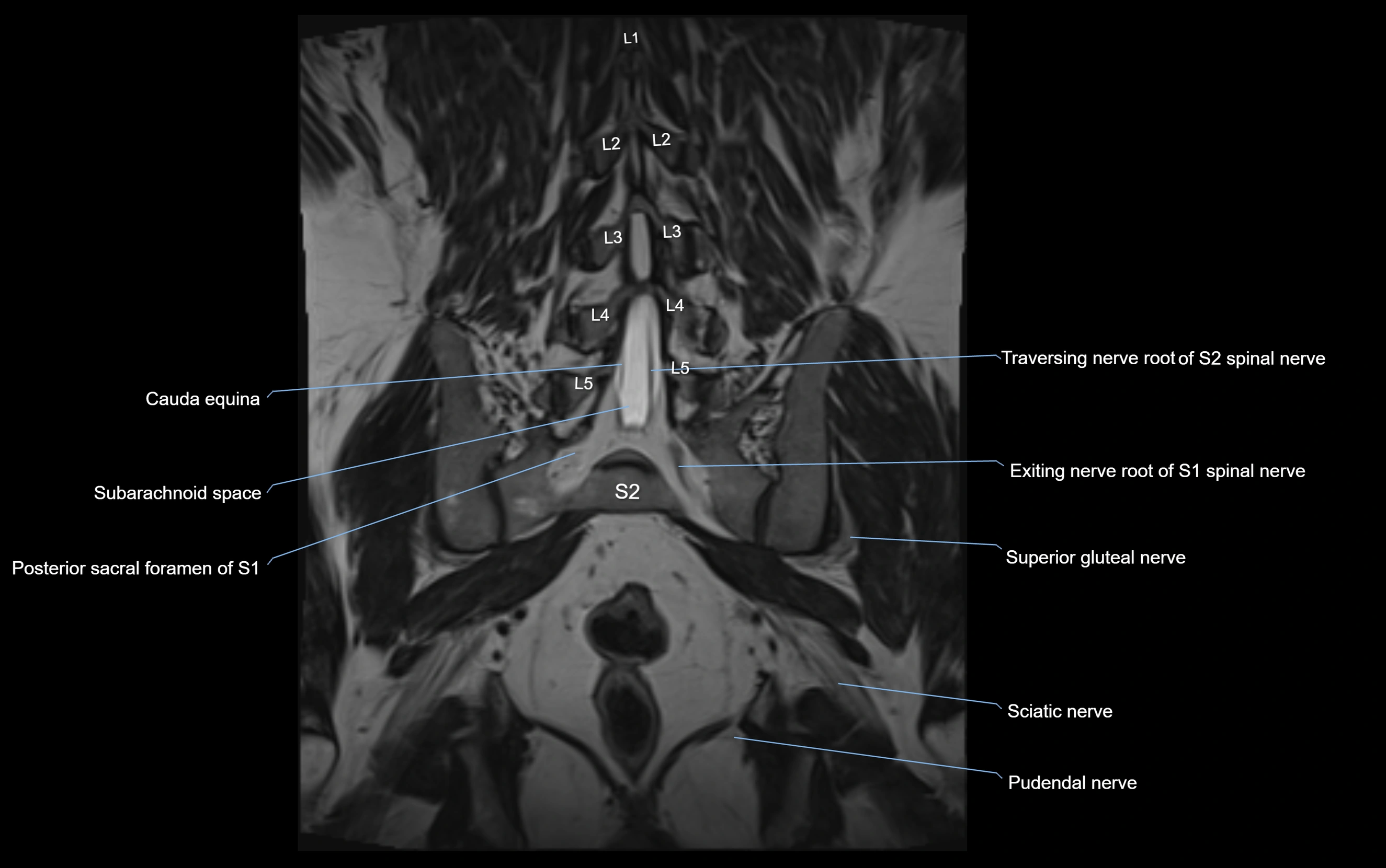 MR lumbosacral plexus cross sectional anatomy 3T  radiology  image-img-09001-00051.webp